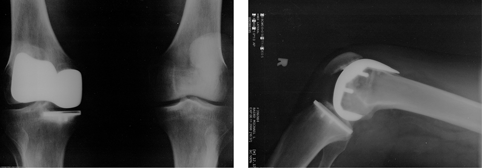 شكل 6.12: الاستبدال الاصطناعي للركبة هو إجراء تم إجراؤه لأكثر من 20 عامًا. تظهر هذه الأشعة السينية بعد الجراحة استبدال مفصل الركبة اليمنى (المصدر: بواسطة مايك بيرد)